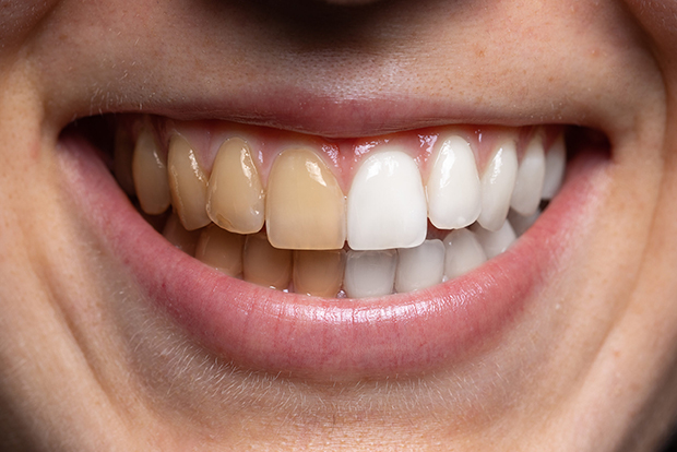 ۶ روش آسان برای سفید کردن دندان ها به صورت طبیعی در خانه
